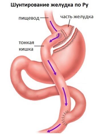 Бариатрия до и после операции Медицинские услуги
